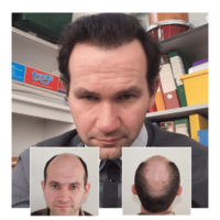 Hair Transplant  Clinic